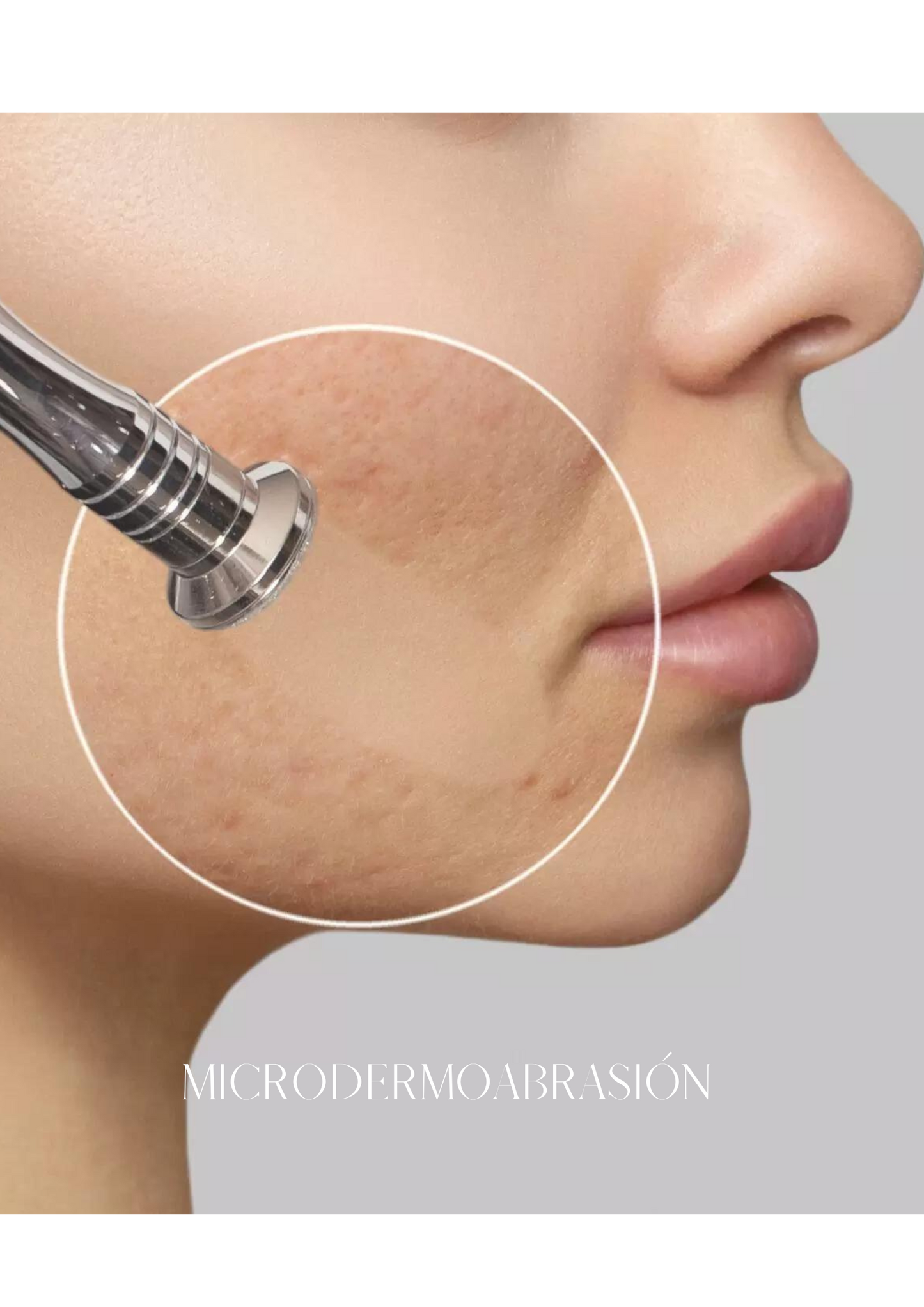 MICRODERMOABRASIÓN